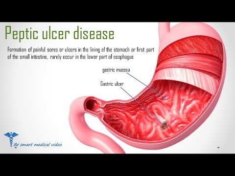 quick-review:-peptic-ulcer-disease-?-causes,-treatment