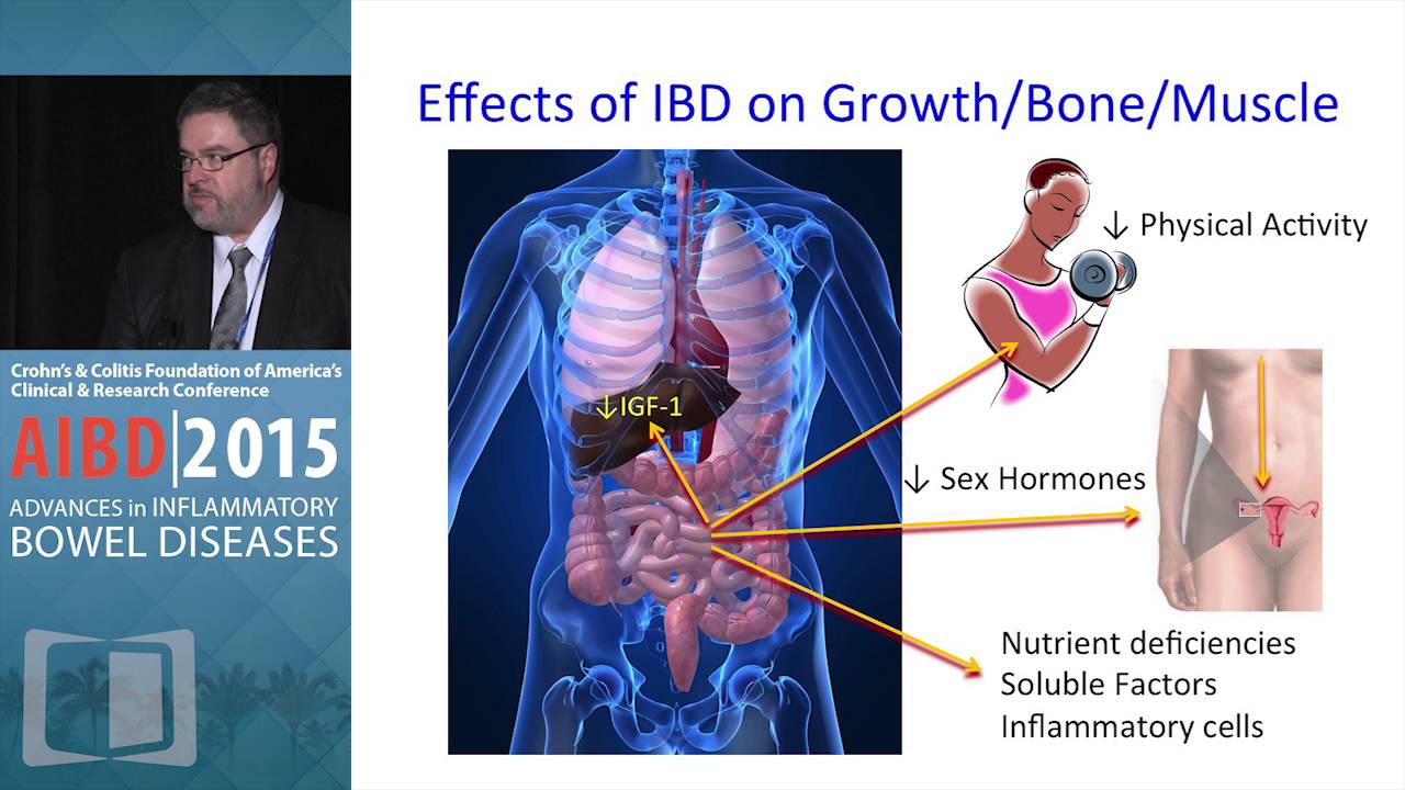 DEBATE Pediatric Patients with Crohn’s Disease and Growth Failure