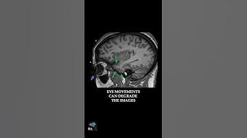 MRI – MPRAGE ARTIFACT SOLUTION