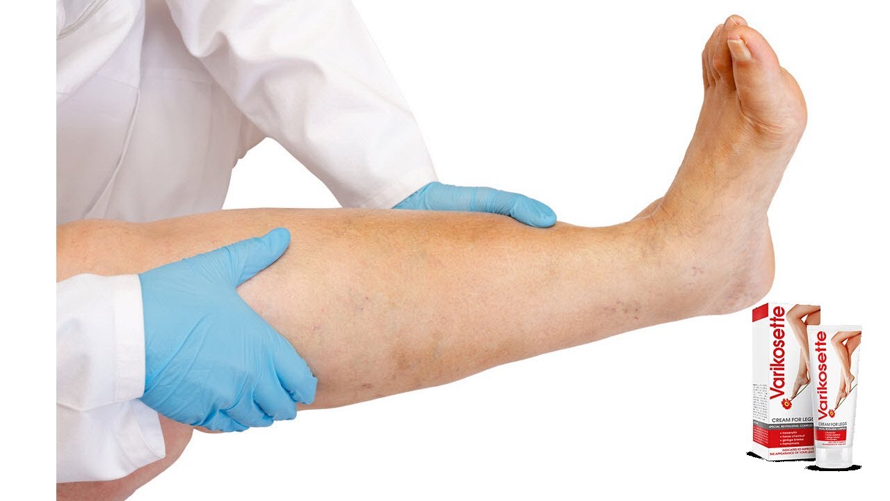 Varikosette - Evita la aparición de várices