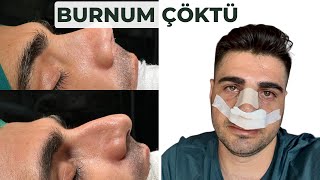 BURUN AMELİYATI SÜRECİM! | 6 AYLIK VLOG | Rüzgar Bilen