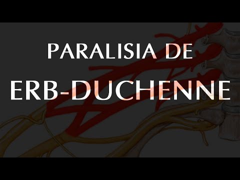 Vídeo: Na paralisia de klumpke a deformidade é chamada?