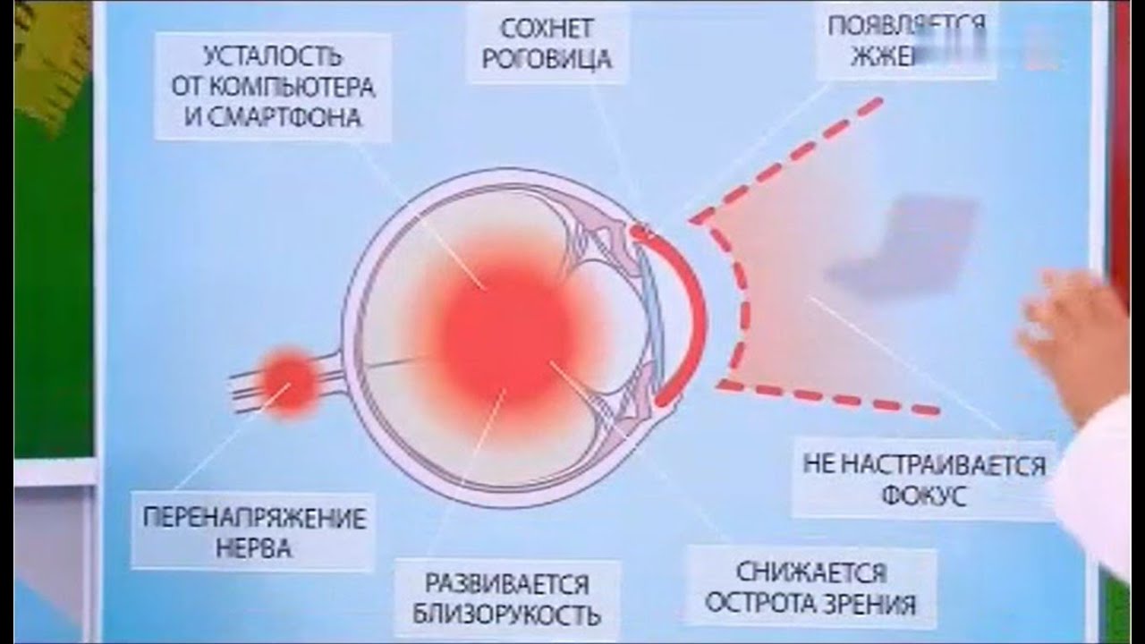 Синдром СУХОГО ГЛАЗА! От сидения за компьютером. - YouTube