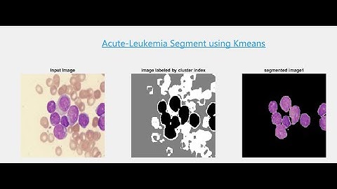 Kmeans Image Segment -- Acute Leukemia Detection