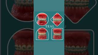 Trending braces colors 5/10/23: TEAL