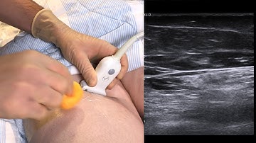 Ultrasound guided saphenus nerve block