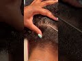 Scratching a Patch of Dandruff | Flaky Scalp #dandruffremoval #scalp scalpscratch #itchyscalp