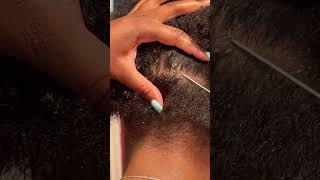Scratching a Patch of Dandruff | Flaky Scalp #dandruffremoval #scalp scalpscratch #itchyscalp screenshot 4