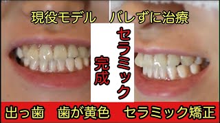 セラミック矯正 前歯 出っ歯 現役モデル 審美歯科 Youtube セラミック矯正 前歯 出っ歯 現役モデル 審美歯科 Youtube