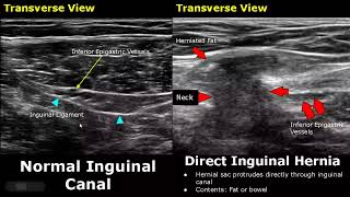Hernia Ultrasound Normal Vs Abnormal Images | Direct\/Indirect Inguinal\/Epigastric\/Femoral Hernia USG