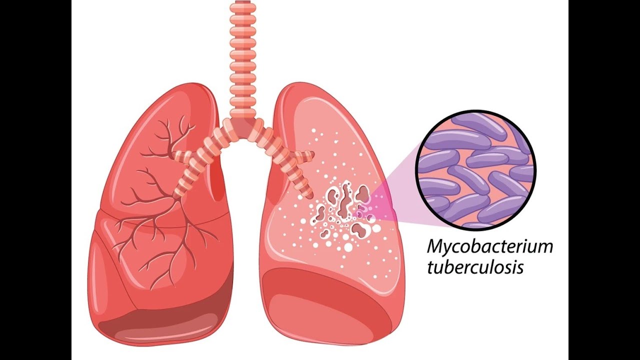 Antitüberküloz İlaçlar
