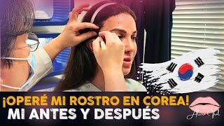 “Deep Plane Lifting: Mi Antes Y Después” 🔥