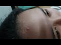 Popping My Sister's Pimple