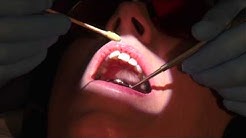 X-tip Anesthesia System - Dr. Scott Norton - Durasi: 2.40. 