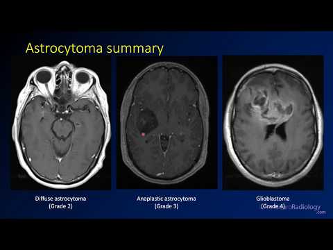 Videó: A Teljes Kópiaszám-variáció Prognosztikai Tényezőként Felnőtt Astrocytoma Altípusokban