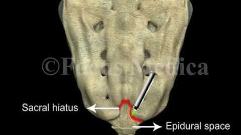 Caudal epidural anesthesia - Back and Spinal Cord