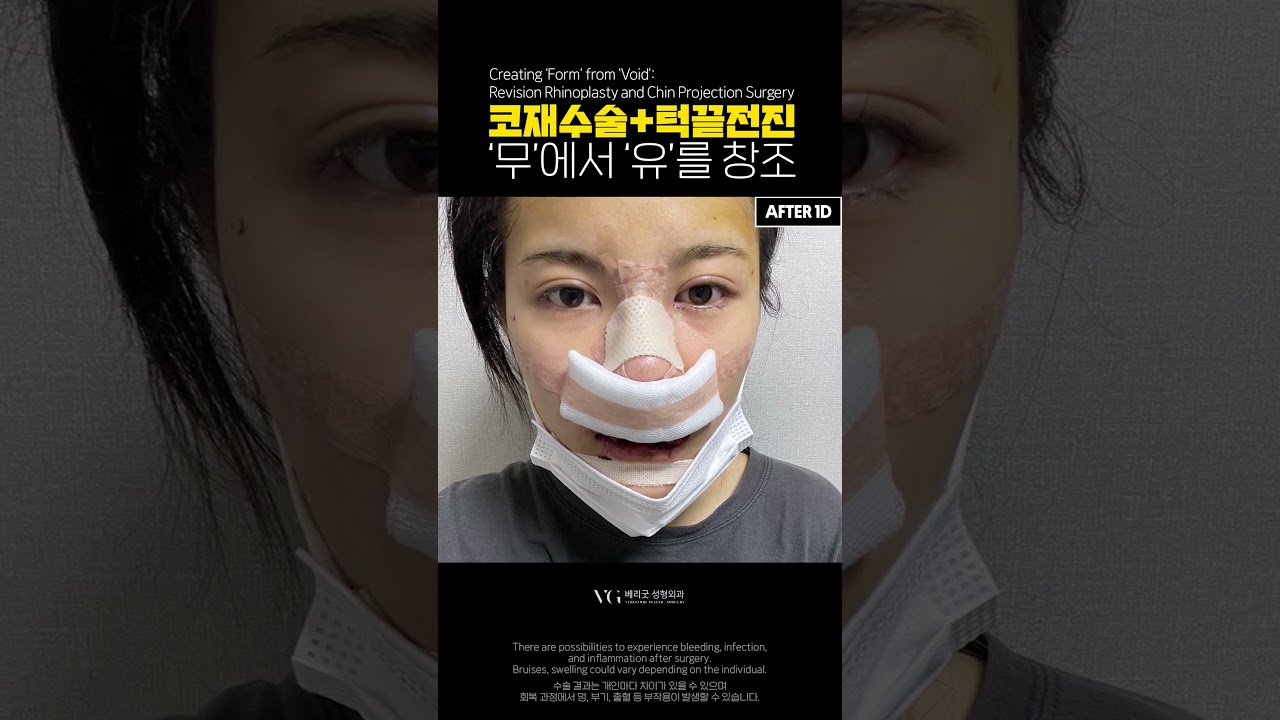 美好整形外科診所 從無到有 鼻部重修手術 + 下巴前移術 傳奇心得