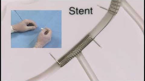 Angioplasty technique: side brunch access through a stent strut