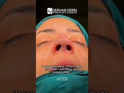 A nosejob journey