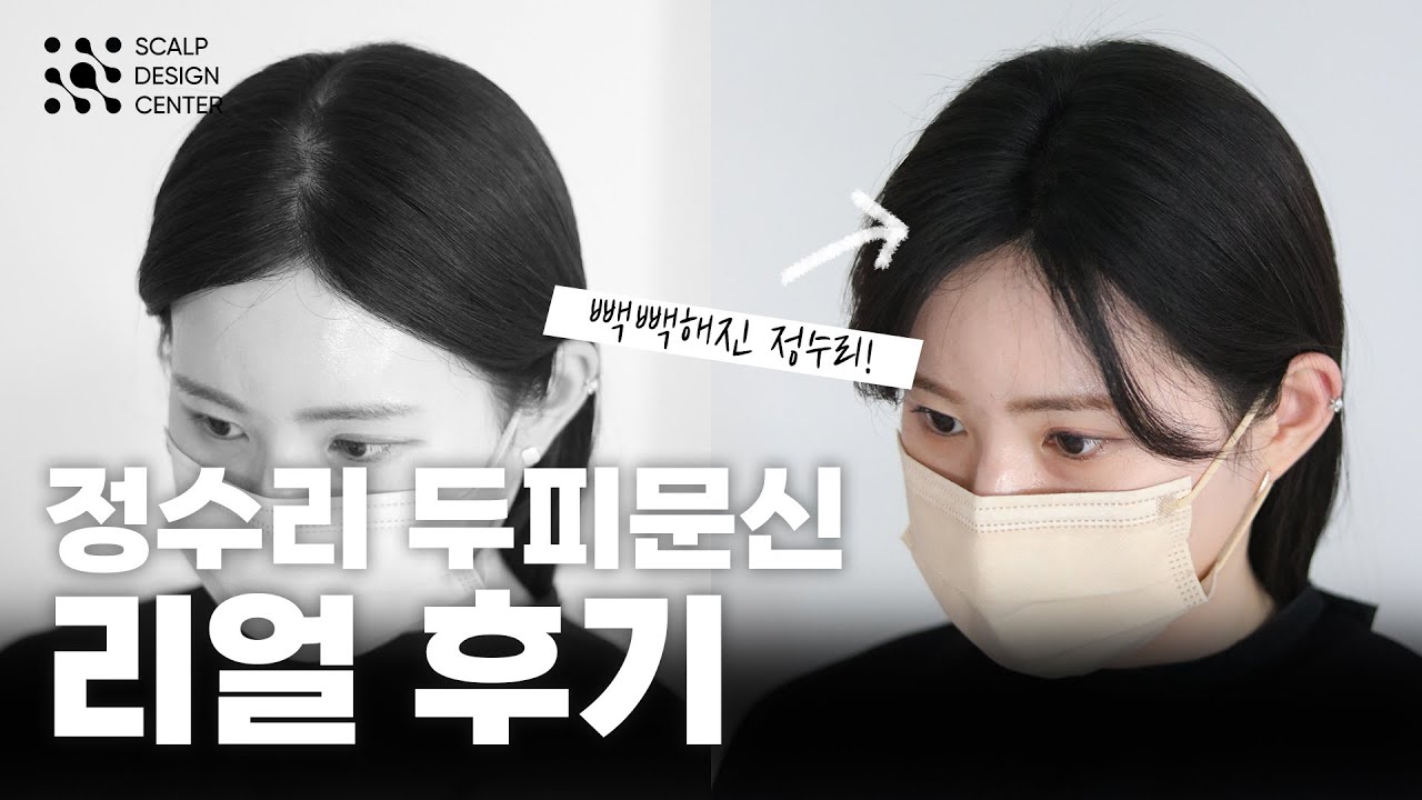 정수리 두피문신을 고민하는 분들께 솔직히 말씀드립니다.
