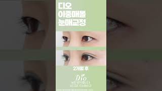붓기 적은 #매몰쌍수 #눈매교정 + #짝눈교정 까지!👀