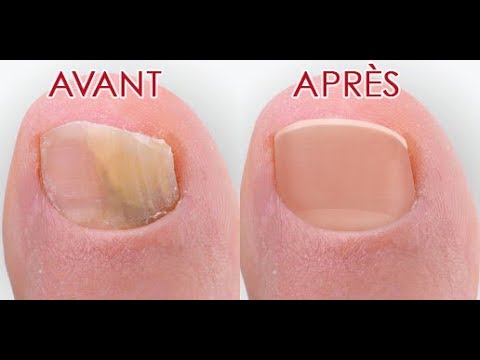 Vidéo: Micoderil contre la mycose des ongles