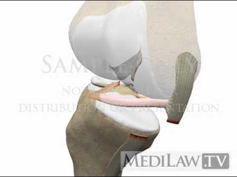 Knee Anterior Cruciate Ligament Rupture Internal Femoral Rotation demonstrative evidence graphics law of supply and demand