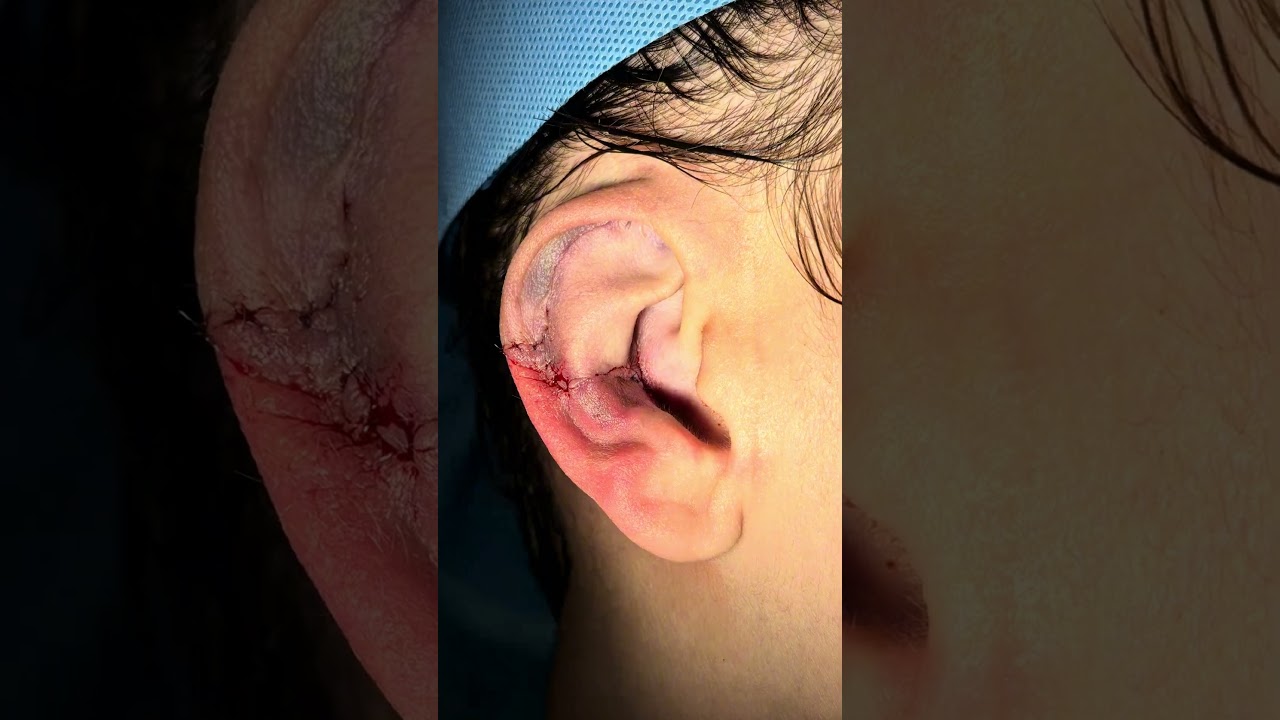 A cirurgia que mais realizo na minha rotina. #otoplastia