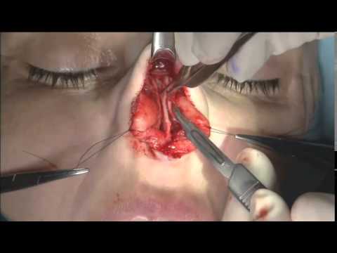 Video thumbnail: Dr. Steven Pearlman Part:6 Hump Reduction