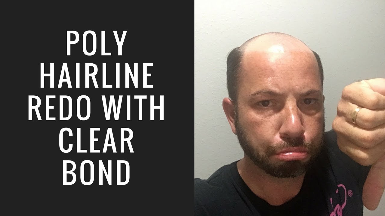 Hair Replacement Hair System Review Poly Hairline Redo Clear Bond