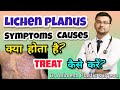 मुँह में सफ़ेद दाग और छाले क्यों होते हैं? क्या है Lichen planus? जाँच और इलाज़ कैसे करें?