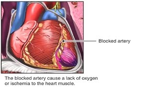 The coronary arteries supply blood to heart muscle itself. damage or
blockage of a artery can result in injury heart. normally, ...