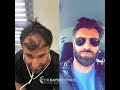 Fue hair transplant results timeline month by month progress  dr bayer clinics