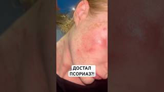 Узнать цену на  Псорифенак можно на Wildberries. Артикул -430728516