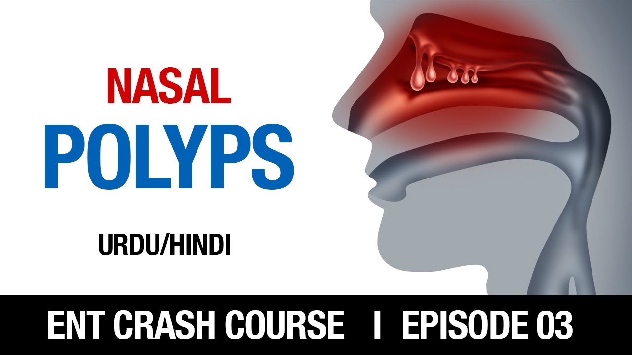 NASAL POLYPS ENT CRASH COURSE EPISODE 3 UNDERGRADUATES URDU