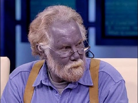 Meet 'Papa Smurf', The Man Whose Skin Turned Blue After Consuming Dietary  Supplements - News18