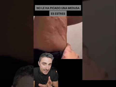 No le ha picado una medusa.#supervivencia #curiosidades #emergencia