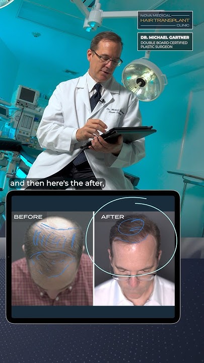 🔎Inside Dr. Gartner's Hair Transplant Expert Insights. Part 2 / 