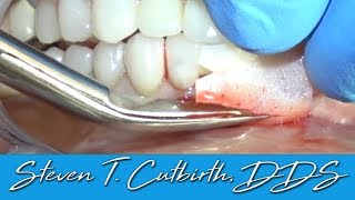 Soft Tissue Grafting  - Dental Minute with Steven T. Cutbirth, DDS screenshot 2