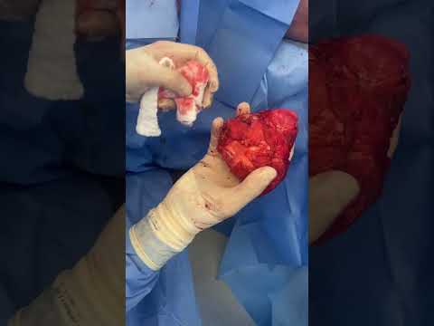 Grade 4 Capsular Contracture