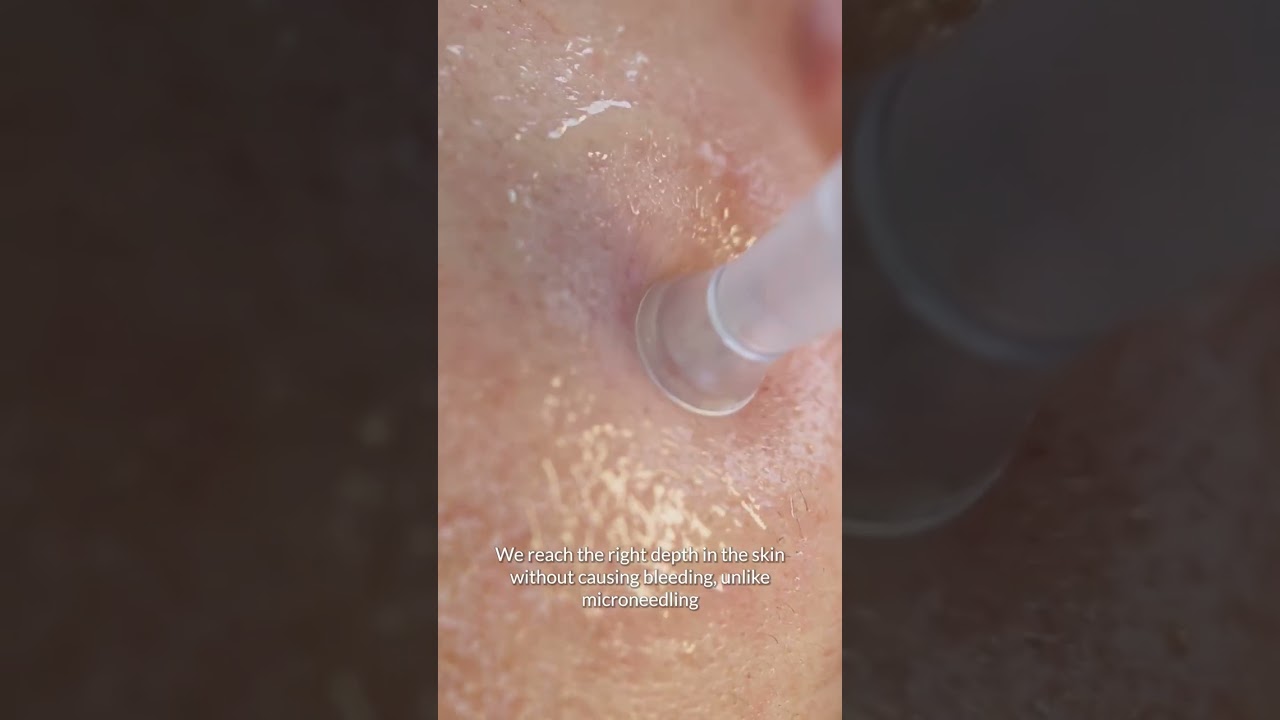 Skin improvement treatment with proven results - Dermatude