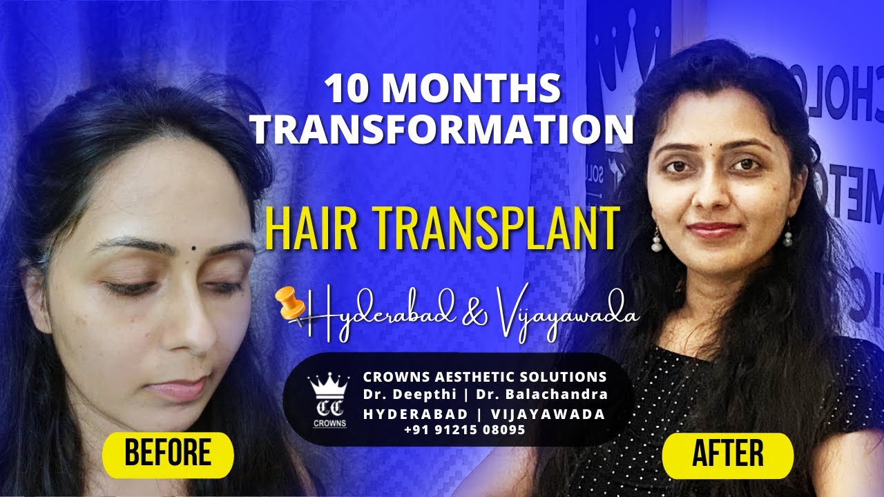 10 MONTHS HAIR TRANSPLANT HYDERABAD | Before and After Hair Transplant |  Crowns Clinic | Dr Deepthi - YouTube