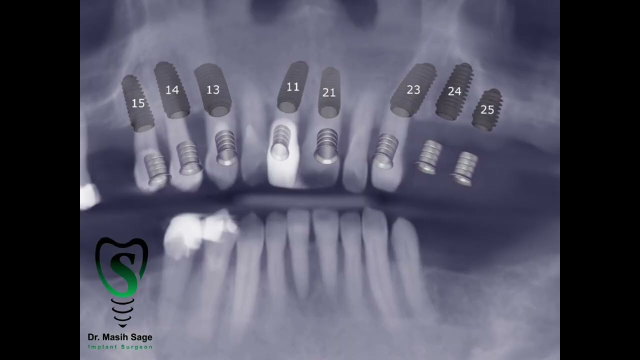 Full arch implant placement