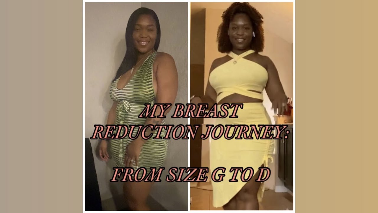 My Breast Reduction Journey Youtube