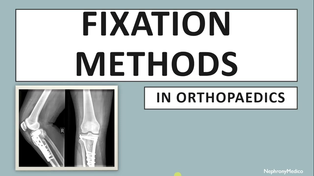 Fixation Methods | Orthopaedics | Rapid Revision | USMLE
