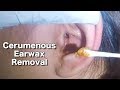 Girl's Cerumenous Earwax Removal & Ear Cleaning