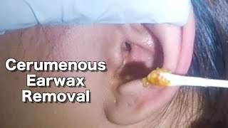 Girl's Cerumenous Earwax Removal & Ear Cleaning