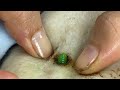 [ASMR] Sharp Ingrown Trimmed! Professional Pedicure DR LEE’S ULTIMATE ZITPOPPER 2509m2 0453
