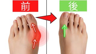 外反母趾が治るって知ってた？その方法とは？