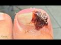😱Unha encravada Transformação Extrema #satisfying #nails